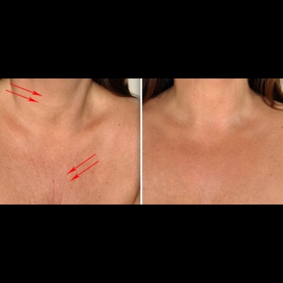 Chest wrinkle ease - Picture 3 of 6